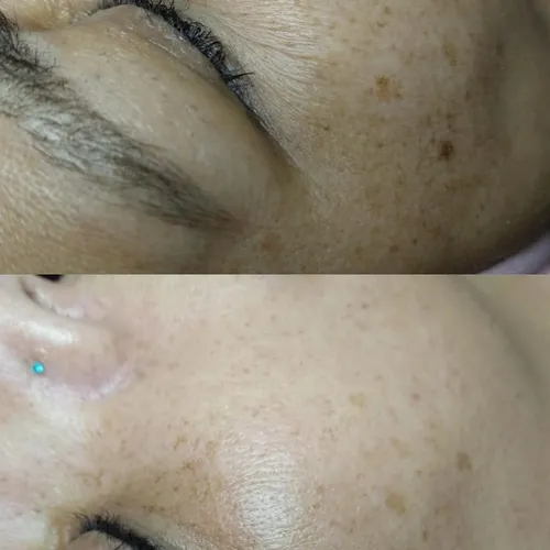 Microneedling · Bioestimulación . Tratamiento de bioestimulación que favorece la renovación cutánea, de Bren.Nailstudy 