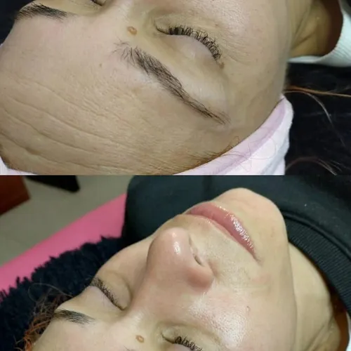 Dermaplaning + Hidra Glow · Luminosidad Intensa ✨ Dermaplaning + peeling hidratante, de Bren.Nailstudy 