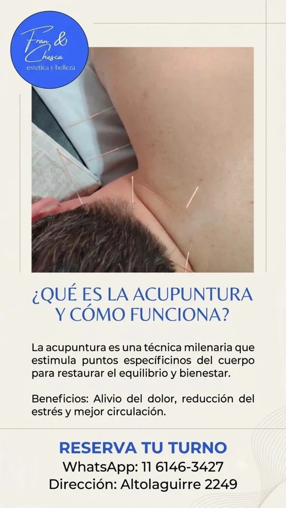 Acupuntura, de Franychescaestetica