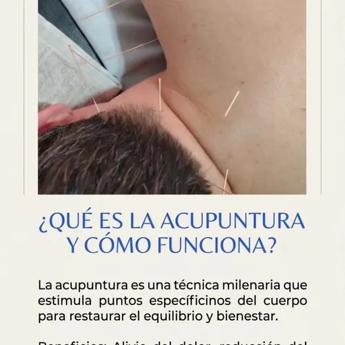 Acupuntura 