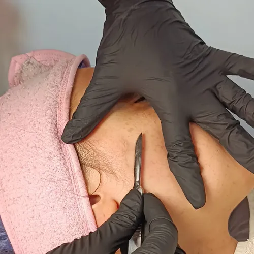Dermaplaning