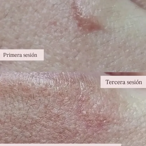 Tratamiento de cicatrices