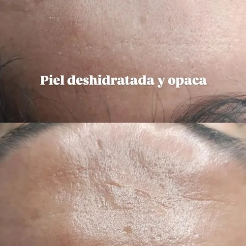 Tratamiento en piel masculina