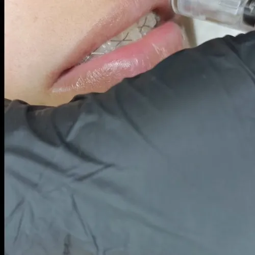 Hidra lips